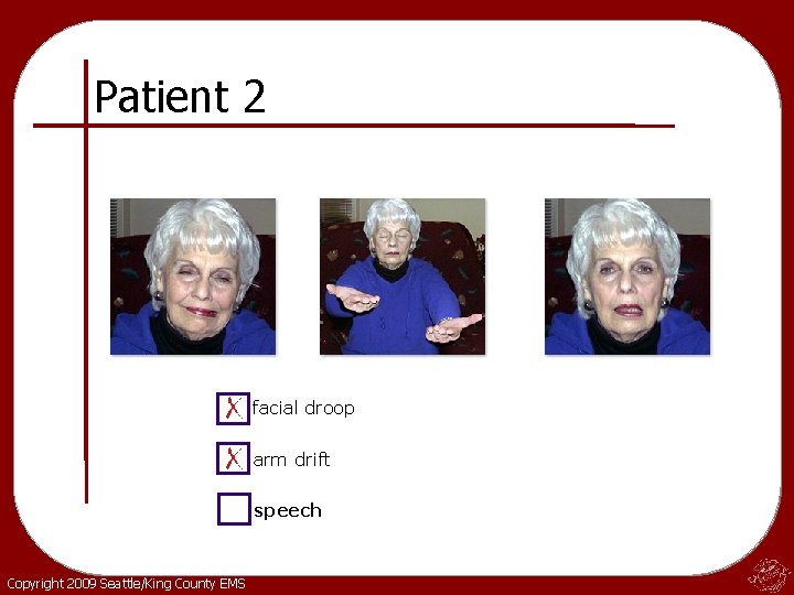 Patient 2 facial droop arm drift speech Copyright 2009 Seattle/King County EMS Patient 2 facial droop arm drift speech Copyright 2009 Seattle/King County EMS