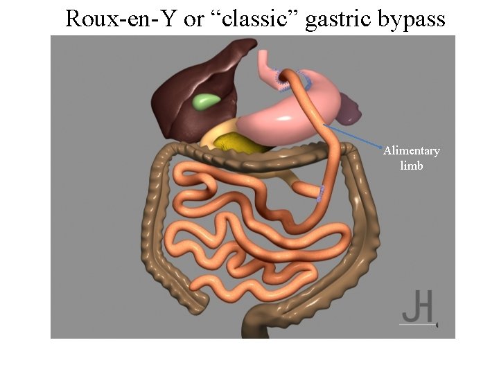 Roux-en-Y or “classic” gastric bypass Alimentary limb 