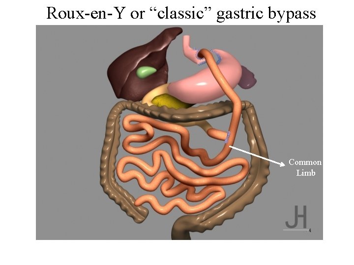 Roux-en-Y or “classic” gastric bypass h Common Limb 