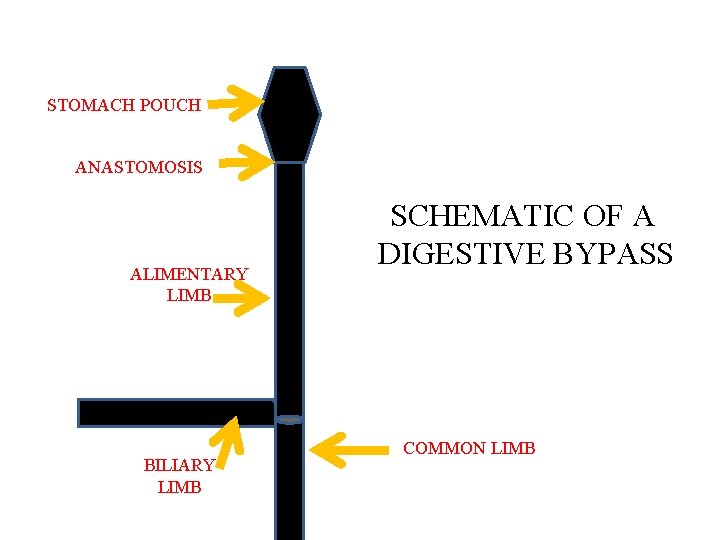 STOMACH POUCH ANASTOMOSIS ALIMENTARY LIMB BILIARY LIMB SCHEMATIC OF A DIGESTIVE BYPASS COMMON LIMB