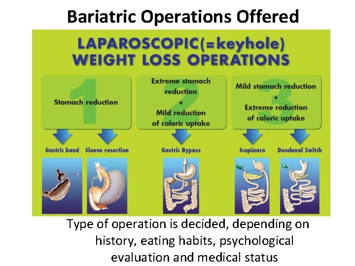 Bariatric Operations Offered Type of operation is decided, depending on history, eating habits, psychological