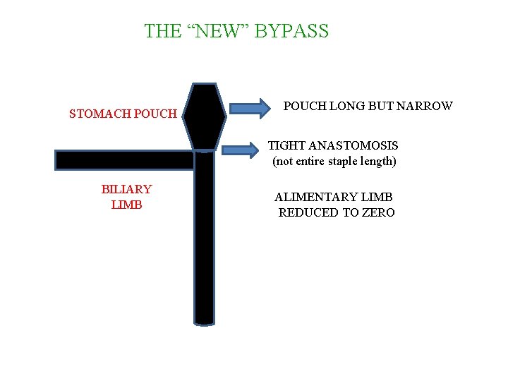 THE “NEW” BYPASS STOMACH POUCH LONG BUT NARROW TIGHT ANASTOMOSIS (not entire staple length)