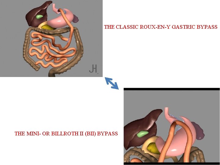 THE CLASSIC ROUX-EN-Y GASTRIC BYPASS THE MINI- OR BILLROTH II (BII) BYPASS 