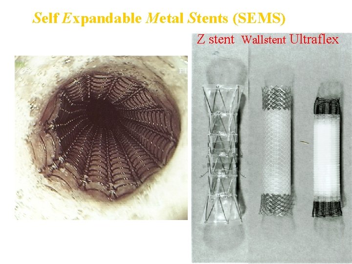 Self Expandable Metal Stents (SEMS) Z stent Wallstent Ultraflex Endoscopic view of the Ultraflex