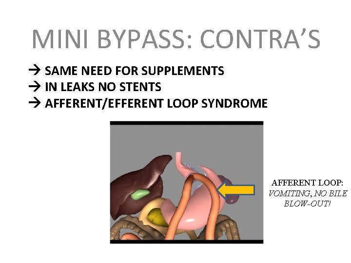 MINI BYPASS: CONTRA’S SAME NEED FOR SUPPLEMENTS IN LEAKS NO STENTS AFFERENT/EFFERENT LOOP SYNDROME