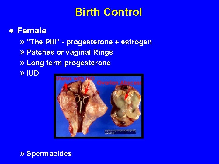 Birth Control l Female » “The Pill” - progesterone + estrogen » Patches or