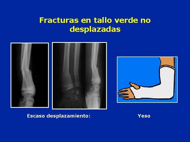 Fracturas en tallo verde no desplazadas Escaso desplazamiento: Yeso 