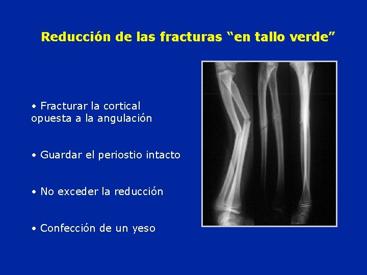 Reducción de las fracturas “en tallo verde” • Fracturar la cortical opuesta a la