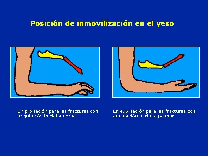 Posición de inmovilización en el yeso En pronación para las fracturas con angulación inicial