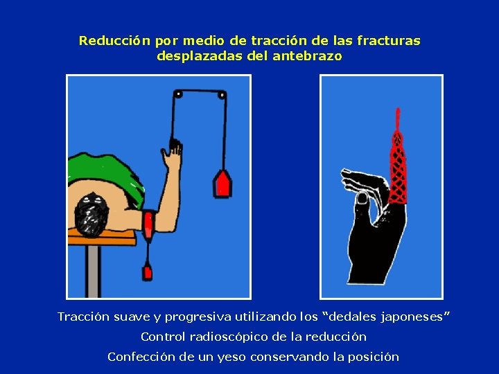 Reducción por medio de tracción de las fracturas desplazadas del antebrazo Tracción suave y