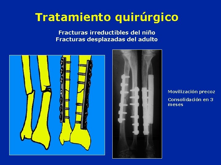 Tratamiento quirúrgico Fracturas irreductibles del niño Fracturas desplazadas del adulto Movilización precoz Consolidación en