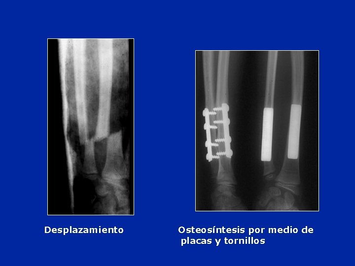 Desplazamiento Osteosíntesis por medio de placas y tornillos 