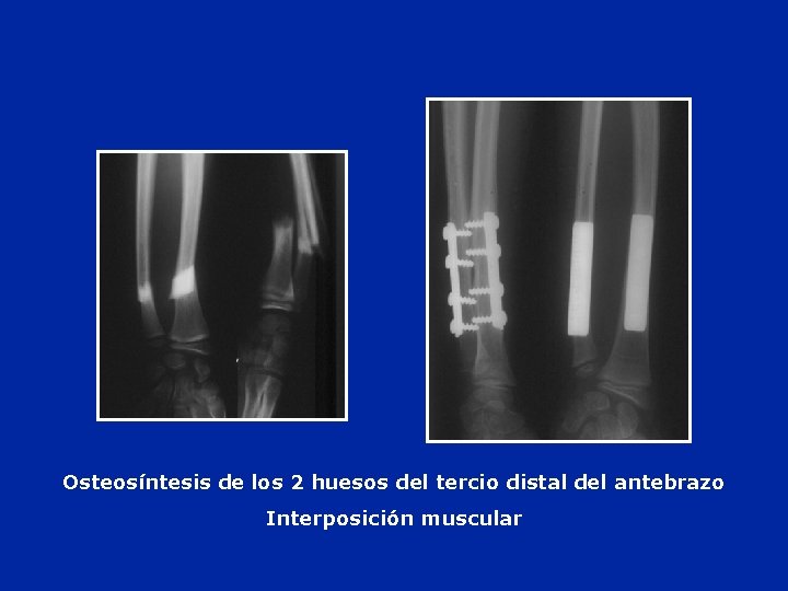 Osteosíntesis de los 2 huesos del tercio distal del antebrazo Interposición muscular 