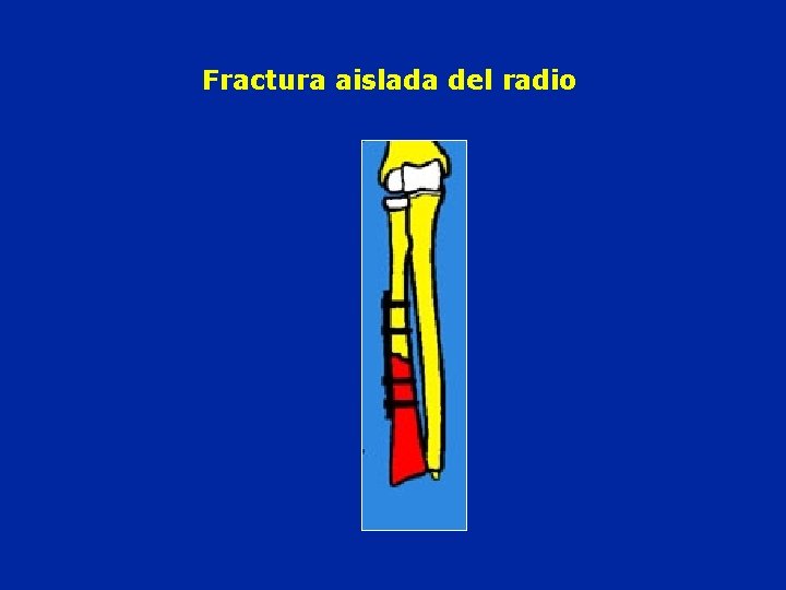 Fractura aislada del radio 