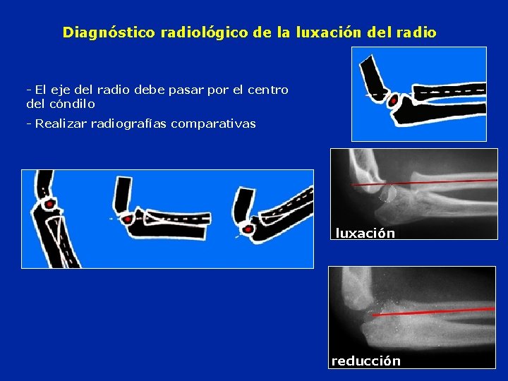 Diagnóstico radiológico de la luxación del radio - El eje del radio debe pasar