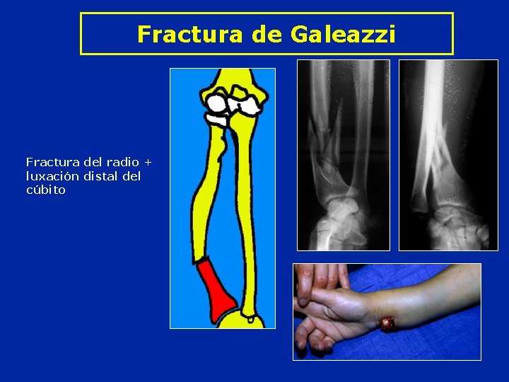 Fractura de Galeazzi Fractura del radio + luxación distal del cúbito 