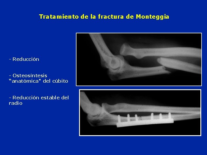 Tratamiento de la fractura de Monteggia - Reducción - Osteosíntesis “anatómica" del cúbito -