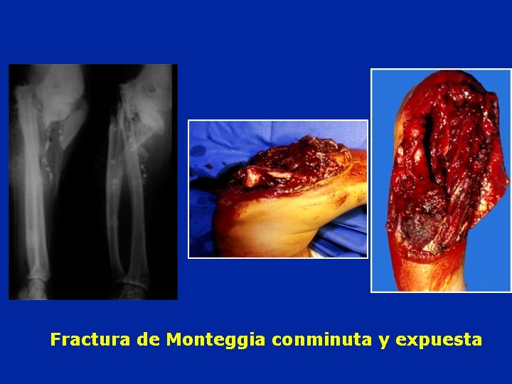 Fractura de Monteggia conminuta y expuesta 