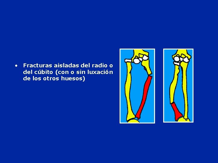  • Fracturas aisladas del radio o del cúbito (con o sin luxación de