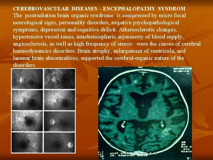 CEREBROVASCULAR DISEASES - ENCEPHALOPATHY SYNDROM The postradiation brain organic syndrome is compressed by micro