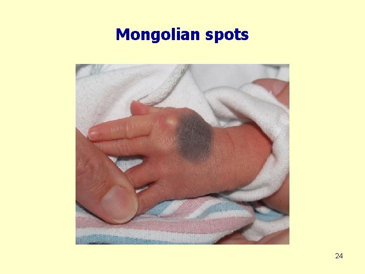 Mongolian spots 24 