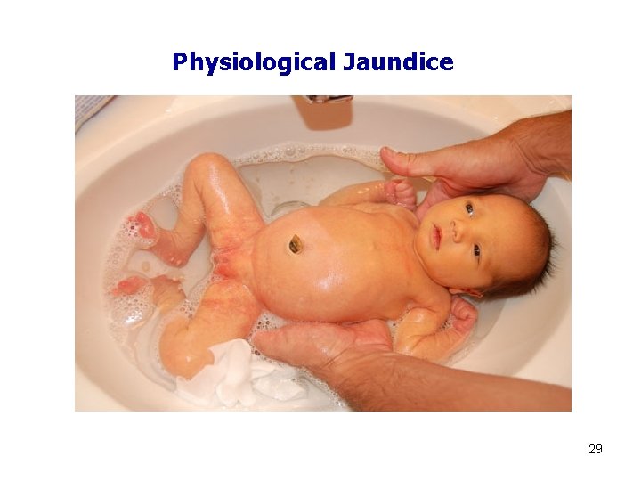 Physiological Jaundice 29 