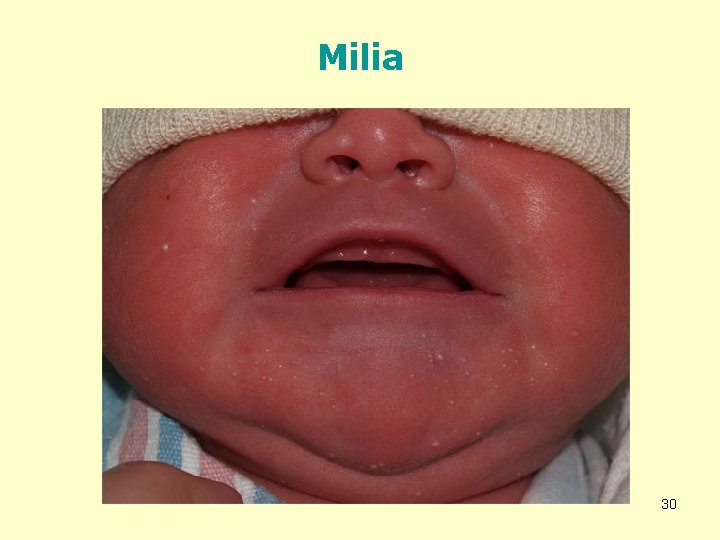 Milia 30 