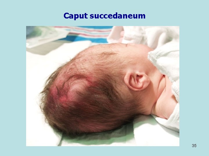 Caput succedaneum 35 