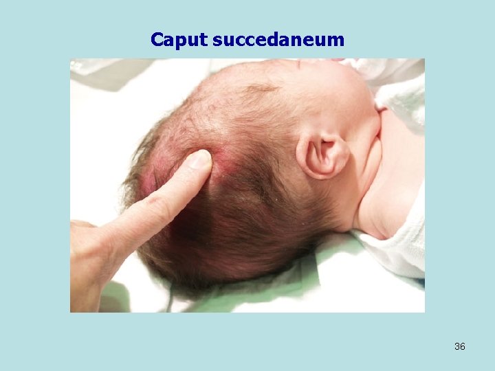 Caput succedaneum 36 