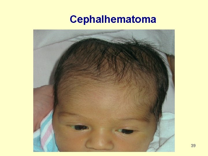 Cephalhematoma 39 
