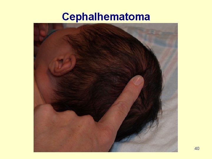 Cephalhematoma 40 