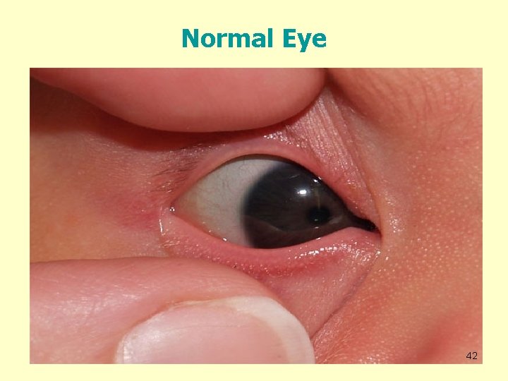 Normal Eye 42 