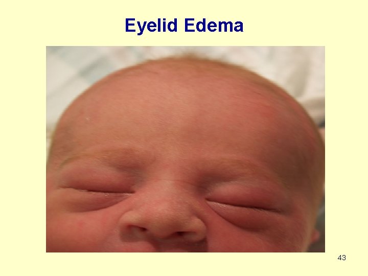 Eyelid Edema 43 