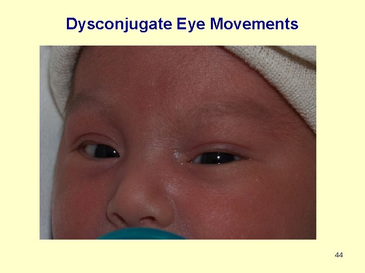 Dysconjugate Eye Movements 44 