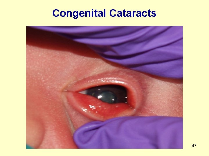 Congenital Cataracts 47 