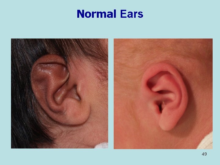 Normal Ears 49 