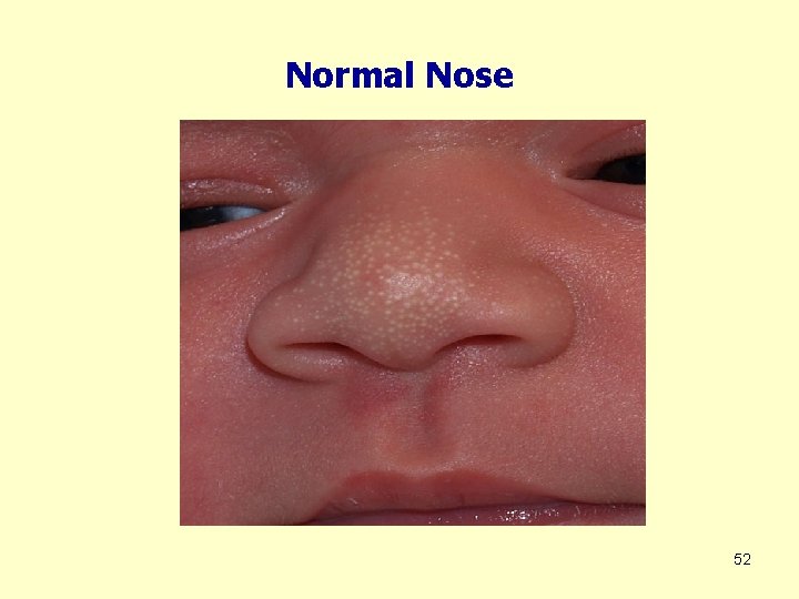Normal Nose 52 