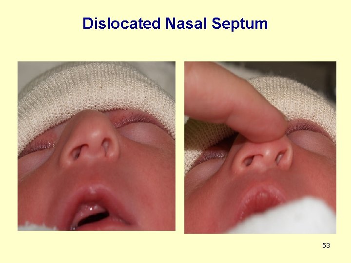 Dislocated Nasal Septum 53 
