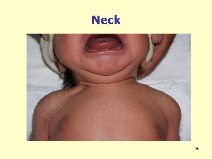 Neck 56 