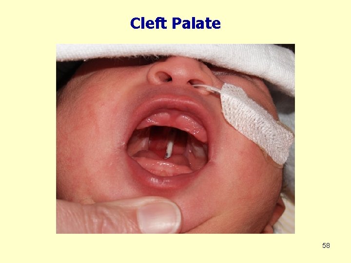 Cleft Palate 58 