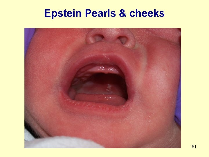 Epstein Pearls & cheeks 61 