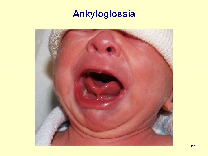 Ankyloglossia 63 