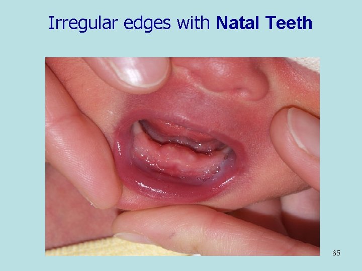 Irregular edges with Natal Teeth 65 