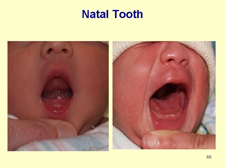 Natal Tooth 66 
