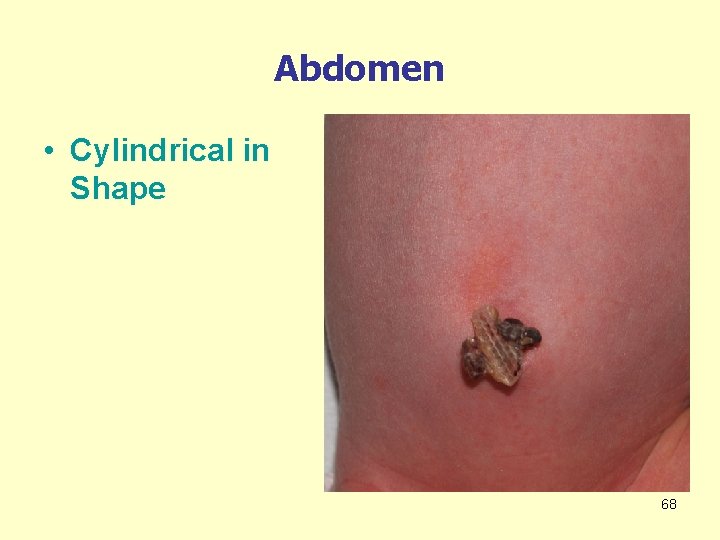 Abdomen • Cylindrical in Shape 68 