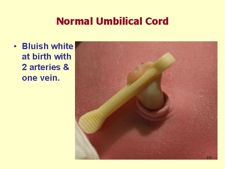 Normal Umbilical Cord • Bluish white at birth with 2 arteries & one vein.