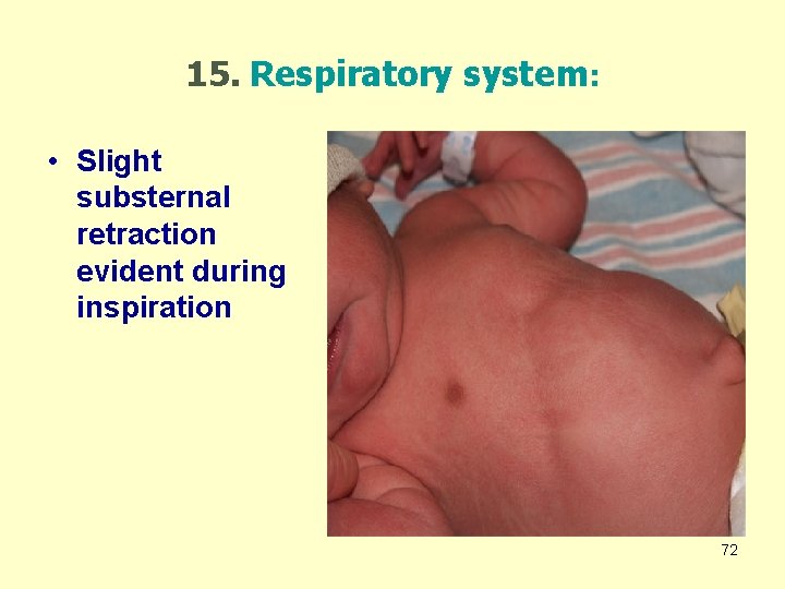 15. Respiratory system: • Slight substernal retraction evident during inspiration 72 