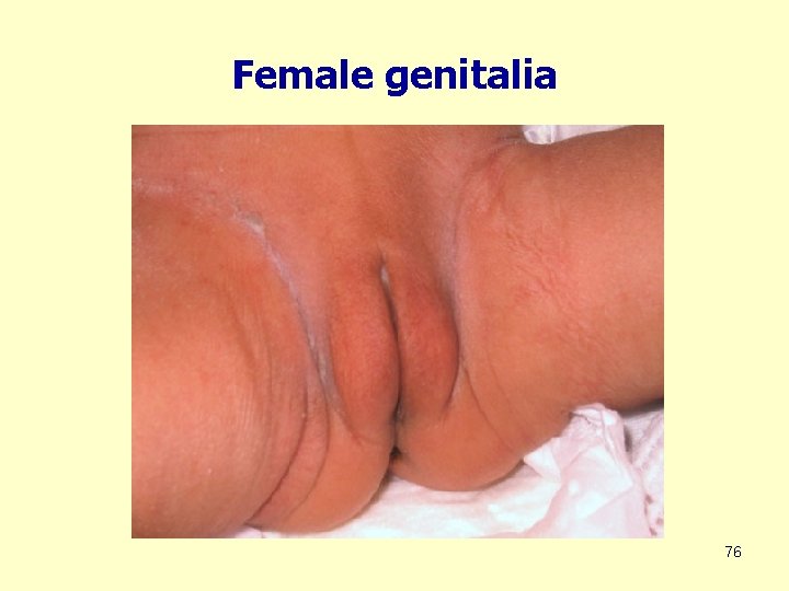 Female genitalia 76 