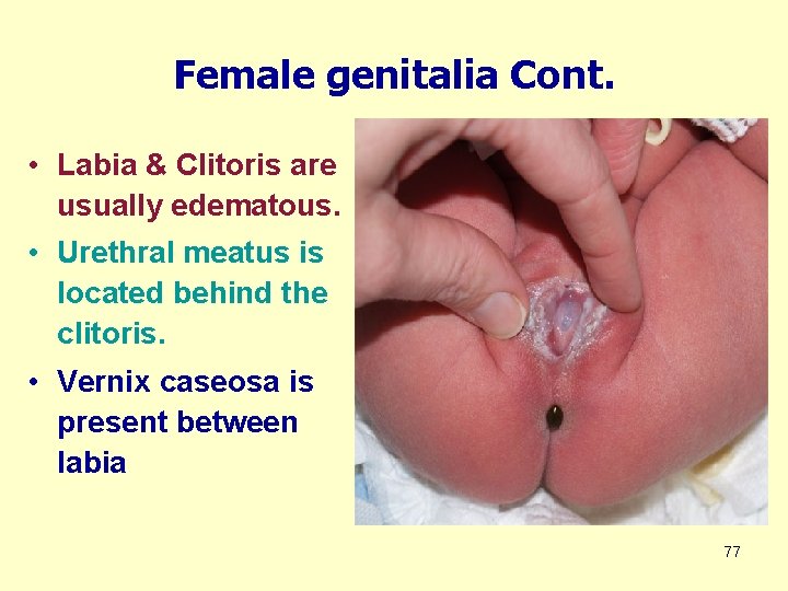 Female genitalia Cont. • Labia & Clitoris are usually edematous. • Urethral meatus is