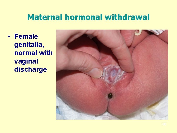 Maternal hormonal withdrawal • Female genitalia, normal with vaginal discharge 80 